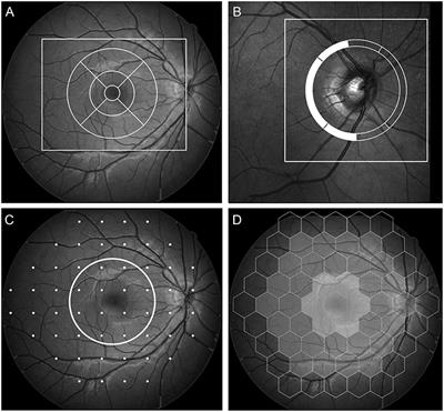 Outer Retinal Dysfunction on Multifocal Electroretinography May Help Differentiating Multiple Sclerosis From Neuromyelitis Optica Spectrum Disorder